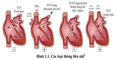 Nghiên cứu ứng dụng siêu âm trong buồng tim hỗ trợ chẩn đoán và can thiệp bít lỗ thông liên nhĩ