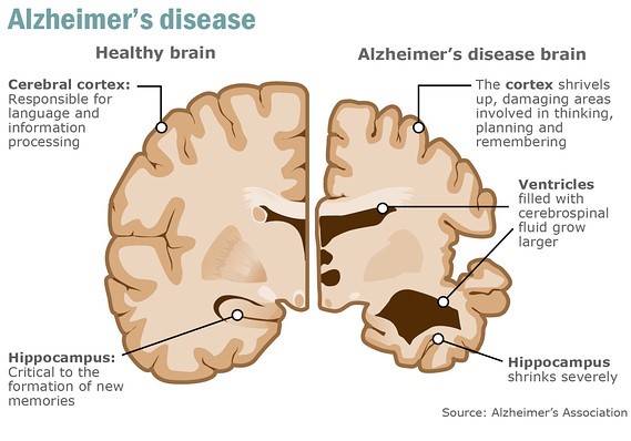 Sử dụng thuốc điều trị herpes để làm chậm bệnh Alzheimer