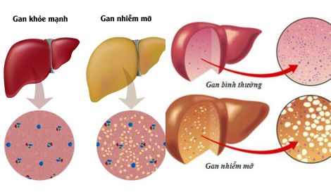 Phương pháp mới điều trị gan nhiễm mỡ