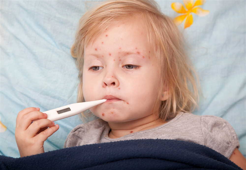 Bệnh Thủy đậu – triệu chứng, cách phòng và xử lý
