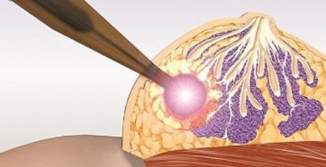 Sử dụng ánh sáng để tiêu diệt ung thư vú di căn