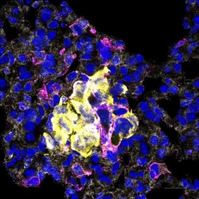 Hạt nano có triển vọng điều trị ung thư vú