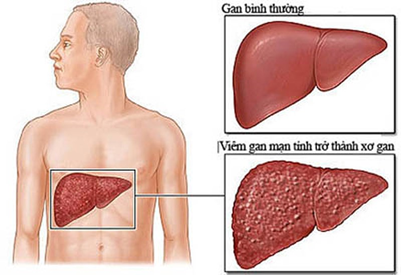 Nghiên cứu đánh giá tác dụng của bài thuốc VG1 trong điều trị viêm gan B mạn tính