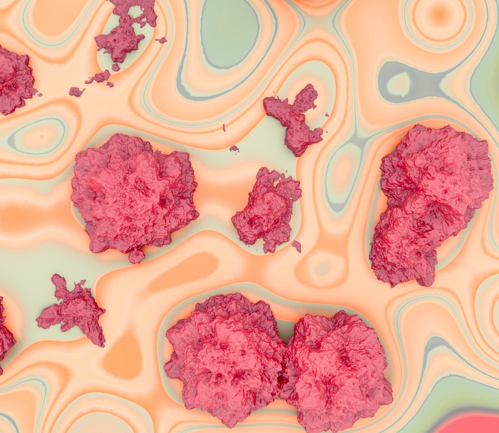 Nghiên cứu cho thấy sự gián đoạn microbiome ruột làm tăng tốc độ di căn của ung thư vú