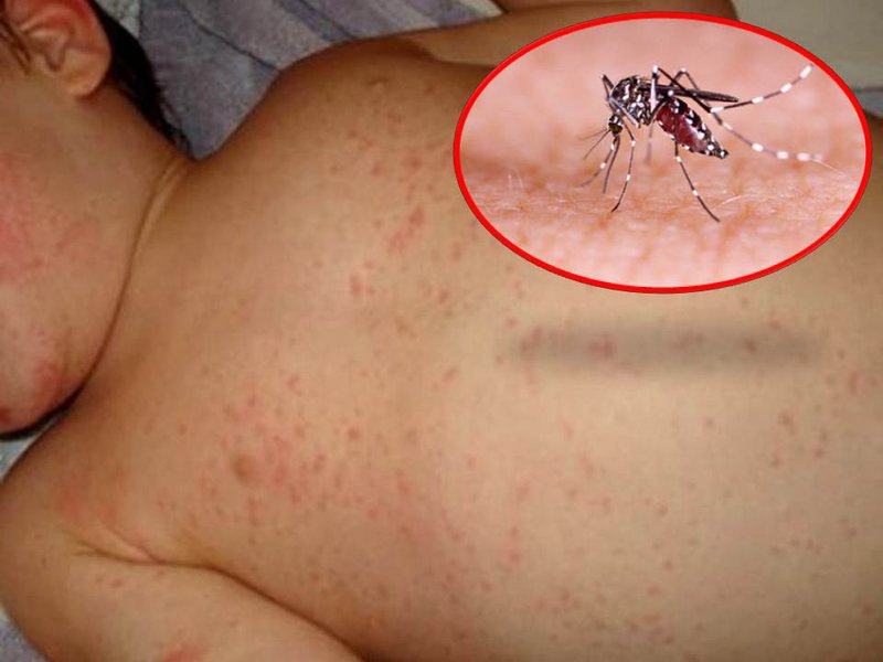 Các dấu hiệu của bệnh sốt xuất huyết và cách điều trị tại nhà trước khi đến bệnh viện