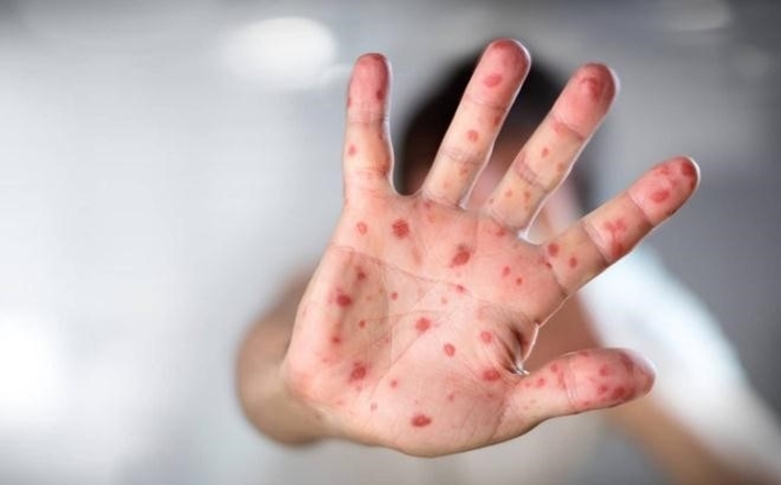 Hướng dẫn phòng và chăm sóc trẻ bị bệnh tay chân miệng