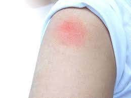 Đau bắp tay sau khi tiêm vaccine Covid-19 và cách giảm đau hiệu quả