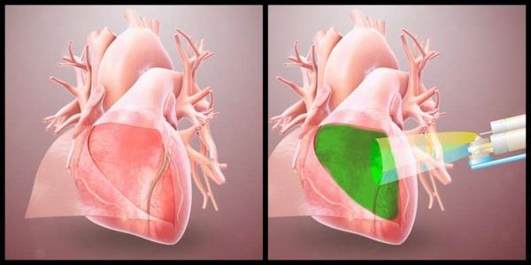 Hydrogel sinh học chống dính mô tim sau phẫu thuật