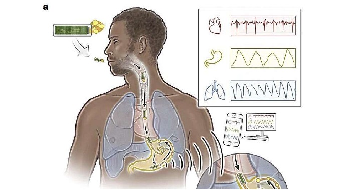 Thiết bị y tế ghi lại hoạt động điện sinh lý của dạ dày