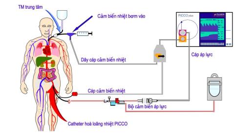 Nghiên cứu ứng dụng kỹ thuật thăm dò huyết động bằng phương pháp PiCCO trong điều trị sốc nặng tại Bệnh viện Hữu nghị Việt Tiệp