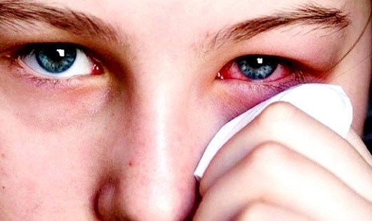 Những điều cần biết về đau mắt đỏ