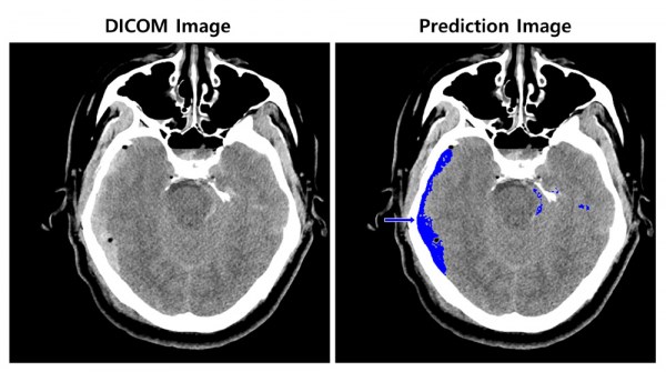 Phổ biến công nghệ đọc hình ảnh xuất huyết não bằng AI tại Hàn Quốc