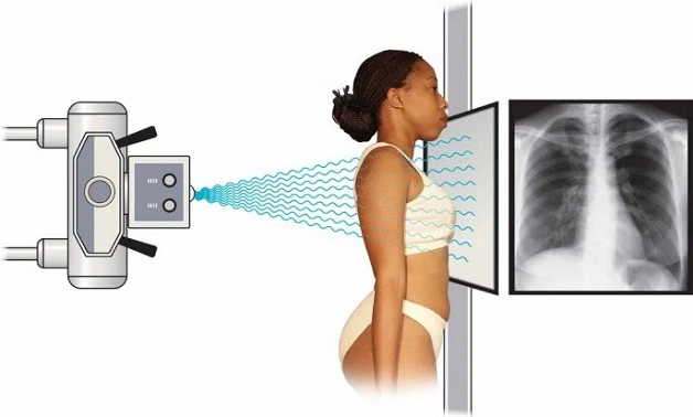 Nghiên cứu đầu tiên trên thế giới về ứng dụng AI trong chụp X-quang ngực