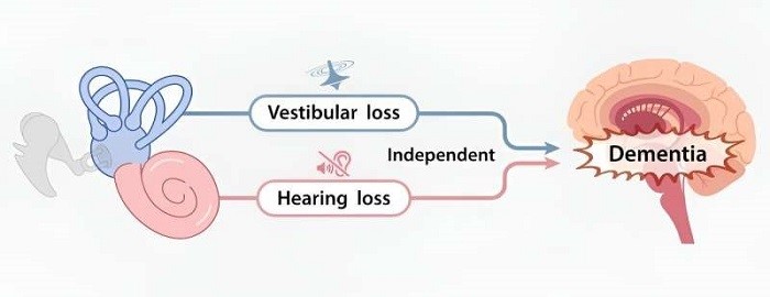 Nghiên cứu quy mô lớn mới bổ sung bằng chứng cho thấy mất tiền đình làm tăng nguy cơ sa sút trí tuệ