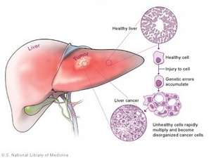 Công bố phát hiện quan trọng về bệnh ung thư gan