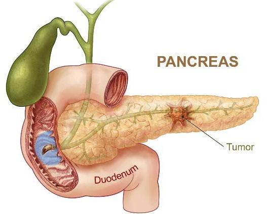 Vi khuẩn ngộ độc thức ăn giúp điều trị ung thư tụy