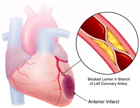 Hy vọng mới cho các bệnh nhân bị nhồi máu cơ tim