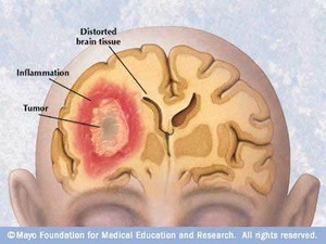 Phát triển công nghệ mới phát hiện sớm bệnh u não