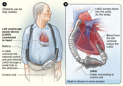 Hy vọng sống cho những bệnh nhân suy tim nặng