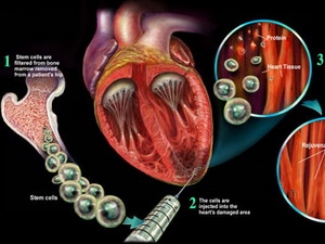 Có thể hồi phục tim bằng tế bào gốc của người lạ