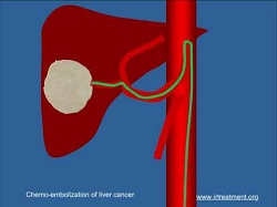 Nút mạch hóa chất - tin vui cho bệnh nhân ung thư gan Hải Phòng