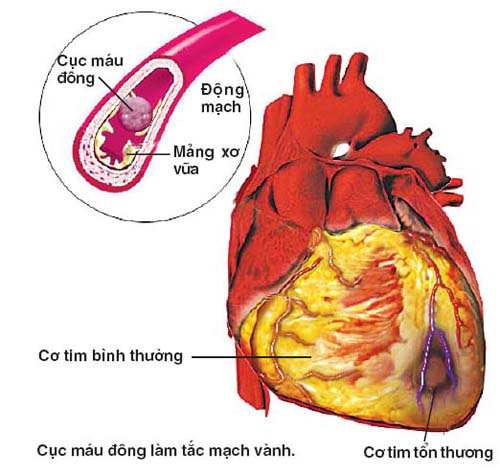 Bệnh tim mạch và cách chữa trị
