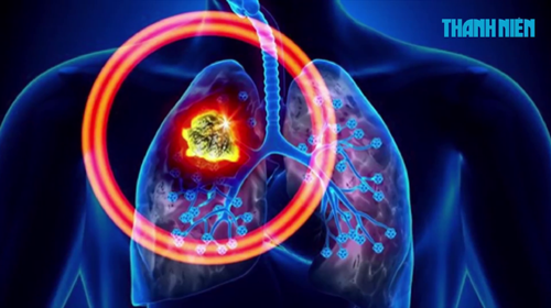 Cách phát hiện sớm ung thư phổi