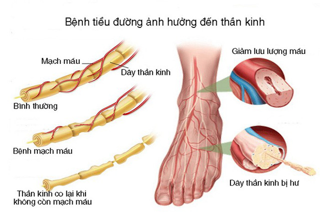 Bài thuốc trị viêm dây thần kinh ngoại biên