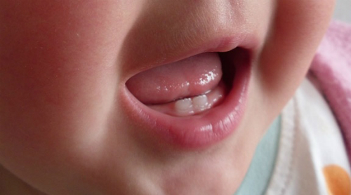 Phòng trị viêm loét miệng ở trẻ