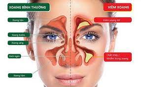 7 cách giảm nghẹt mũi, đau đầu cho người bệnh viêm xoang